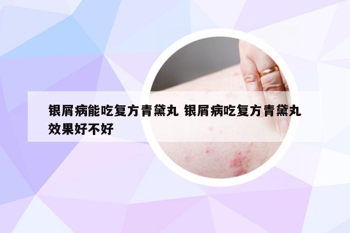 银屑病能吃复方青黛丸 银屑病吃复方青黛丸效果好不好