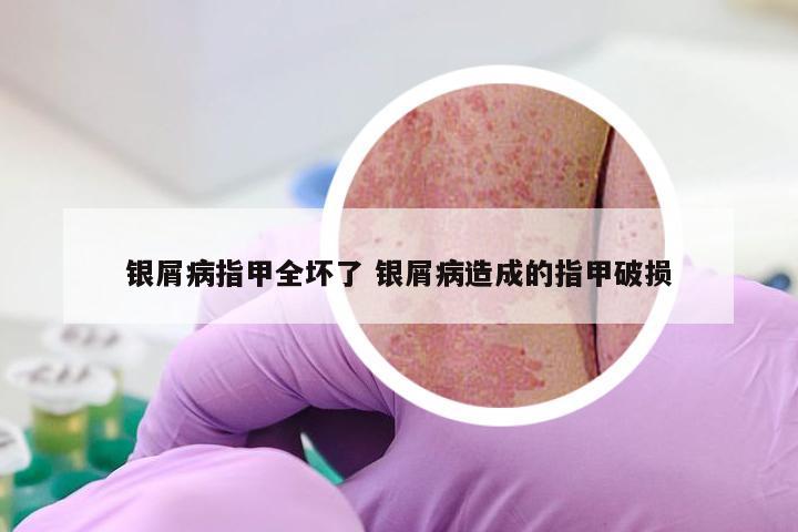 银屑病指甲全坏了 银屑病造成的指甲破损