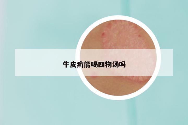 牛皮癣能喝四物汤吗