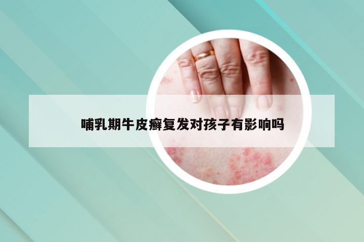 哺乳期牛皮癣复发对孩子有影响吗