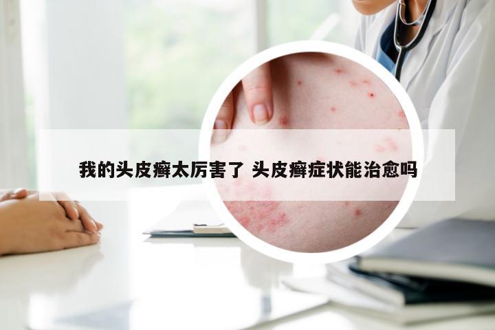 我的头皮癣太厉害了 头皮癣症状能治愈吗