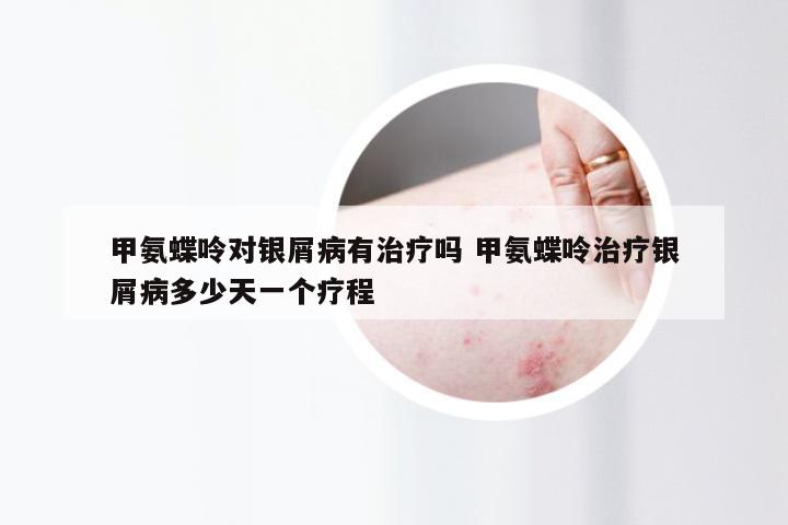 甲氨蝶呤对银屑病有治疗吗 甲氨蝶呤治疗银屑病多少天一个疗程