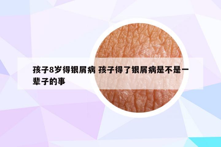 孩子8岁得银屑病 孩子得了银屑病是不是一辈子的事