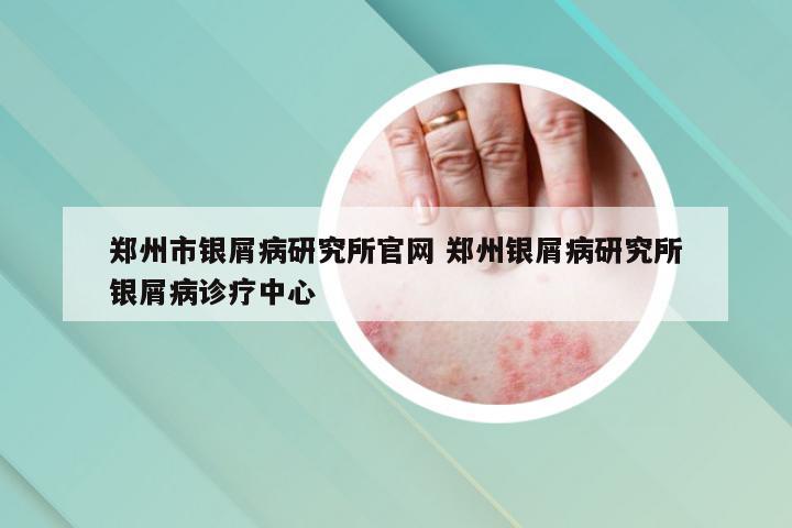 郑州市银屑病研究所官网 郑州银屑病研究所银屑病诊疗中心