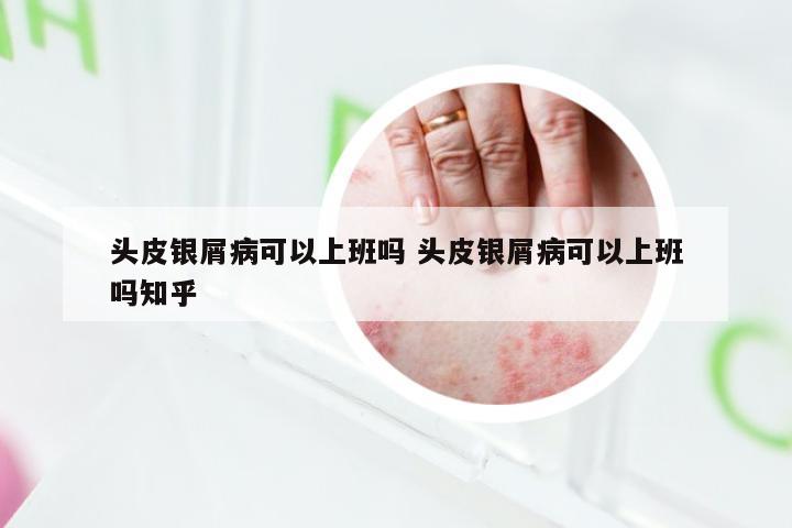头皮银屑病可以上班吗 头皮银屑病可以上班吗知乎