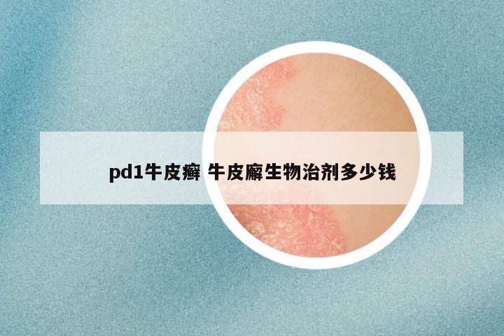 pd1牛皮癣 牛皮廨生物治剂多少钱