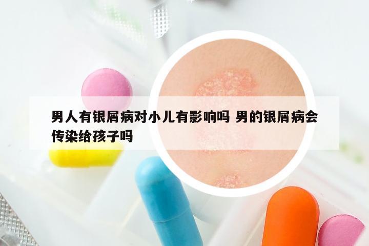 男人有银屑病对小儿有影响吗 男的银屑病会传染给孩子吗