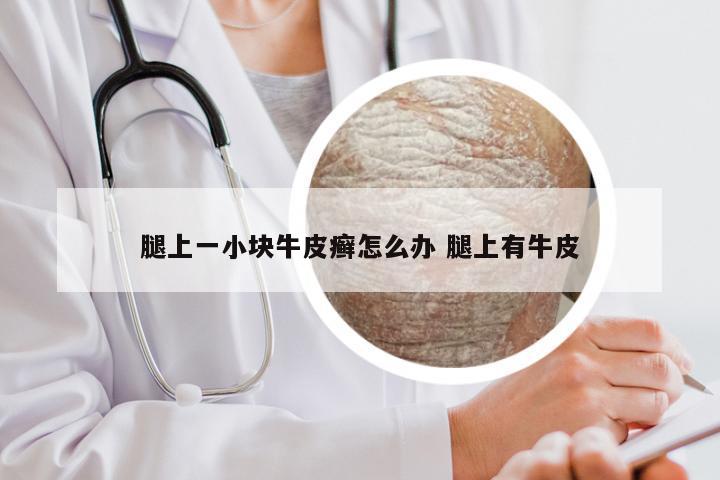 腿上一小块牛皮癣怎么办 腿上有牛皮