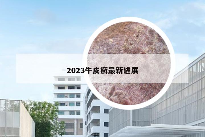 2023牛皮癣最新进展