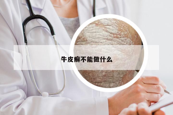 牛皮癣不能做什么