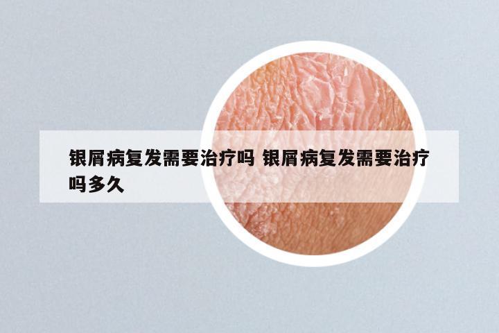 银屑病复发需要治疗吗 银屑病复发需要治疗吗多久