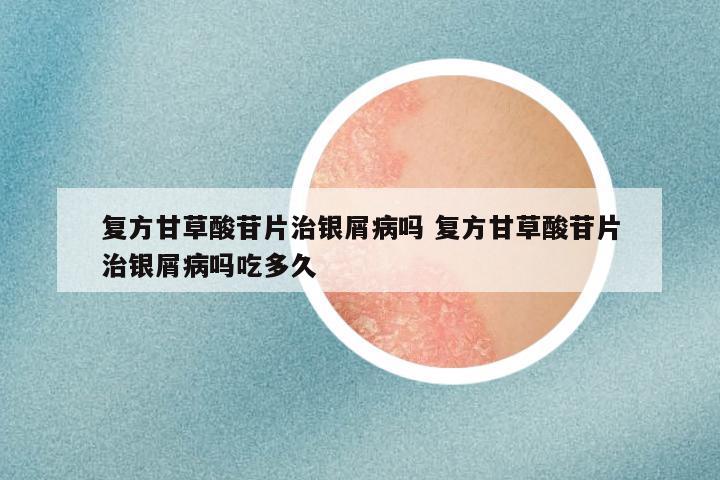 复方甘草酸苷片治银屑病吗 复方甘草酸苷片治银屑病吗吃多久