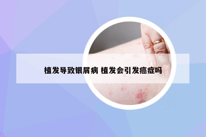 植发导致银屑病 植发会引发癌症吗