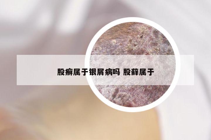 股癣属于银屑病吗 股藓属于