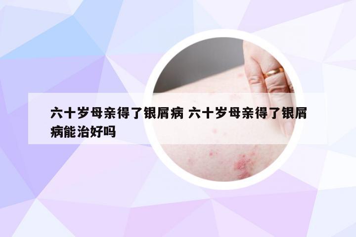 六十岁母亲得了银屑病 六十岁母亲得了银屑病能治好吗