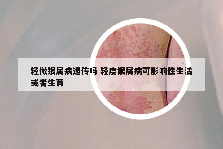 轻微银屑病遗传吗 轻度银屑病可影响性生活或者生育