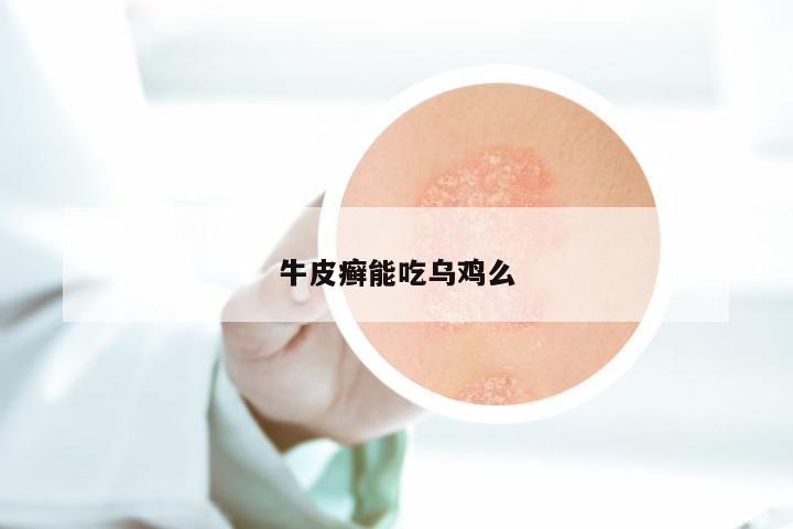 牛皮癣能吃乌鸡么