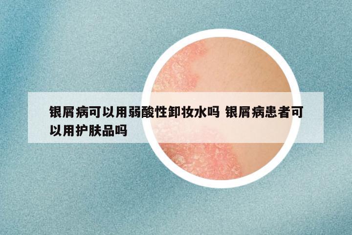 银屑病可以用弱酸性卸妆水吗 银屑病患者可以用护肤品吗