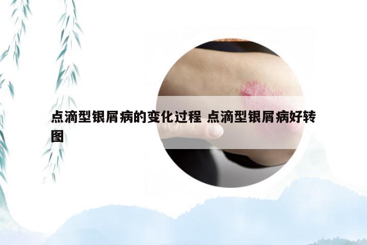 点滴型银屑病的变化过程 点滴型银屑病好转图