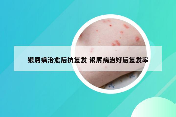 银屑病治愈后抗复发 银屑病治好后复发率