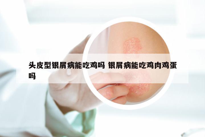 头皮型银屑病能吃鸡吗 银屑病能吃鸡肉鸡蛋吗