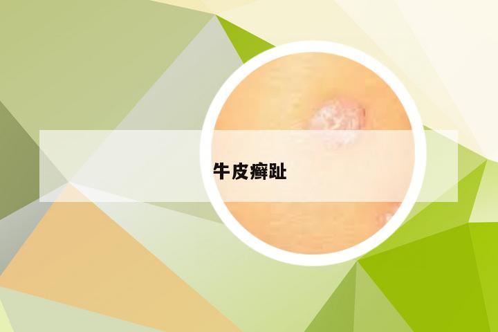 牛皮癣趾