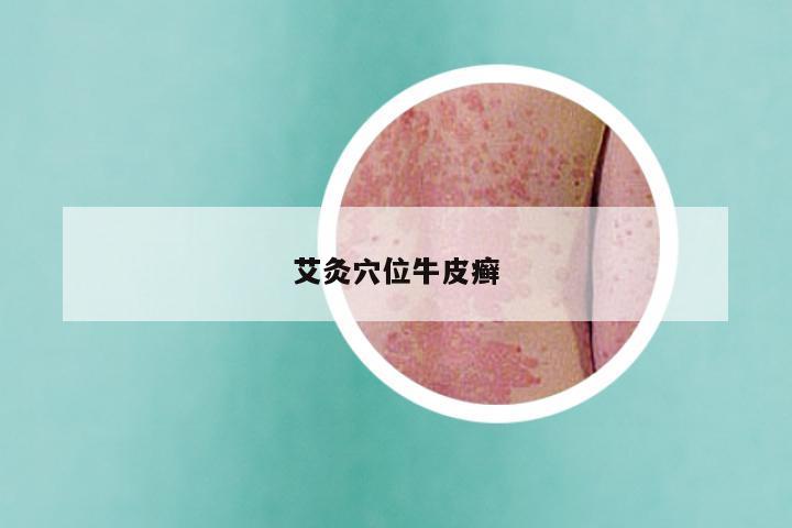 艾灸穴位牛皮癣
