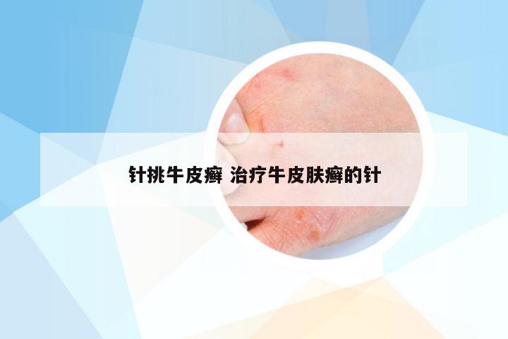 针挑牛皮癣 治疗牛皮肤癣的针