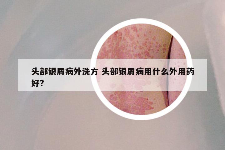 头部银屑病外洗方 头部银屑病用什么外用药好?