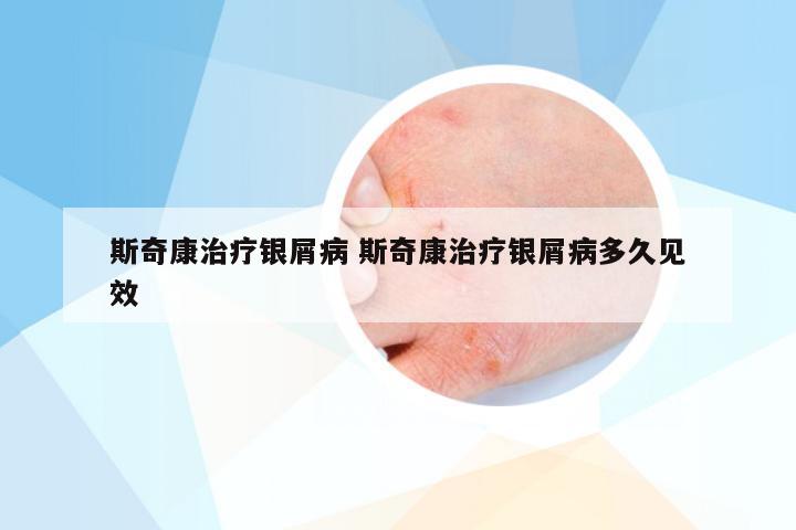 斯奇康治疗银屑病 斯奇康治疗银屑病多久见效