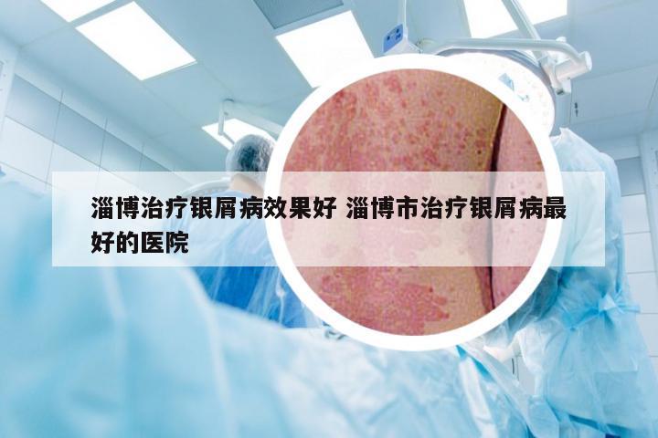 淄博治疗银屑病效果好 淄博市治疗银屑病最好的医院