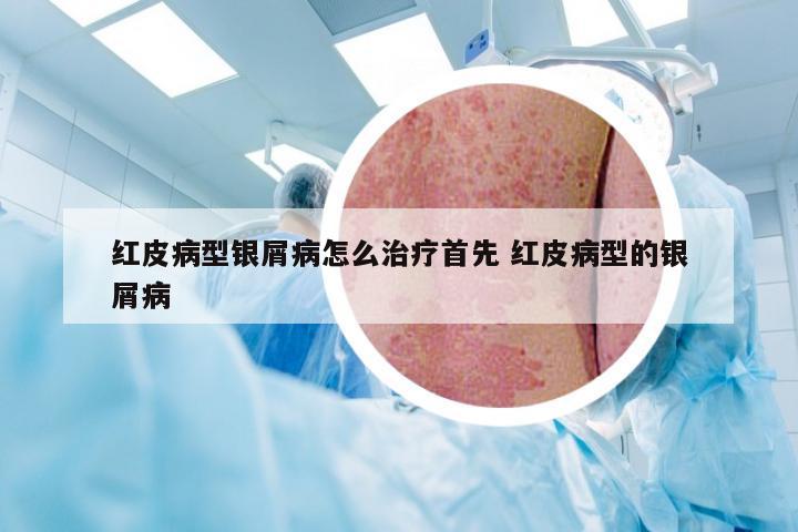 红皮病型银屑病怎么治疗首先 红皮病型的银屑病