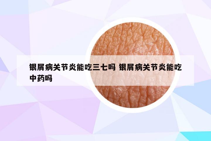 银屑病关节炎能吃三七吗 银屑病关节炎能吃中药吗