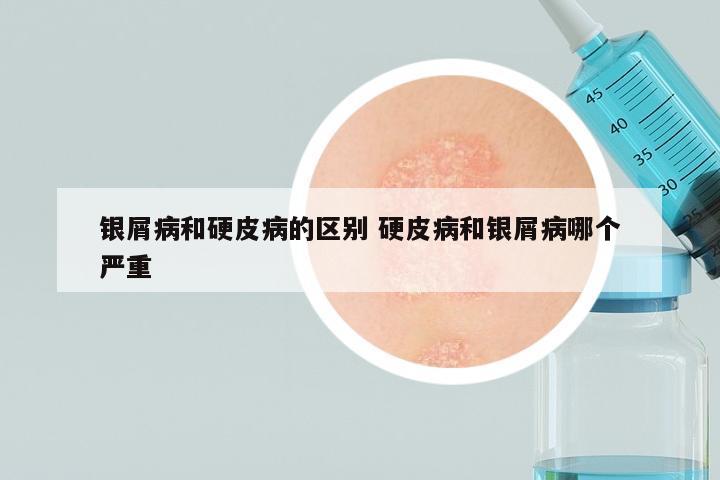 银屑病和硬皮病的区别 硬皮病和银屑病哪个严重