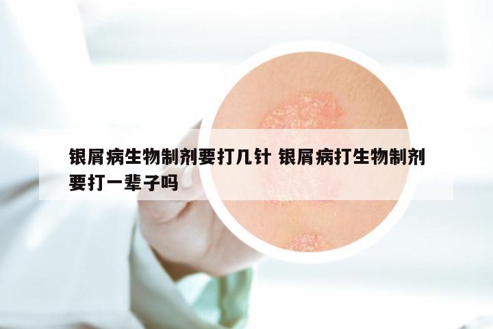 银屑病生物制剂要打几针 银屑病打生物制剂要打一辈子吗