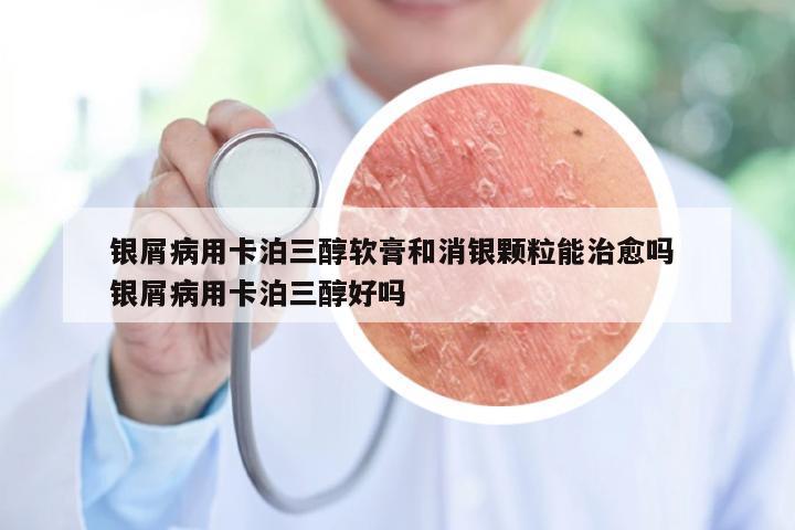 银屑病用卡泊三醇软膏和消银颗粒能治愈吗 银屑病用卡泊三醇好吗