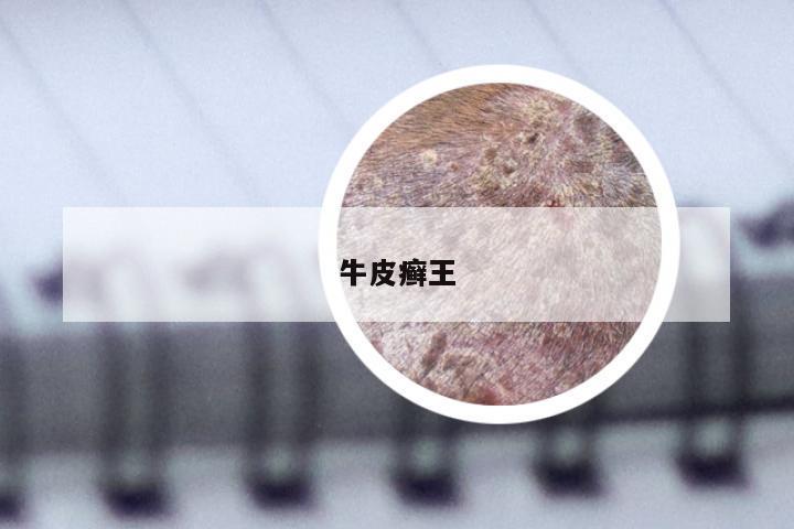 牛皮癣王