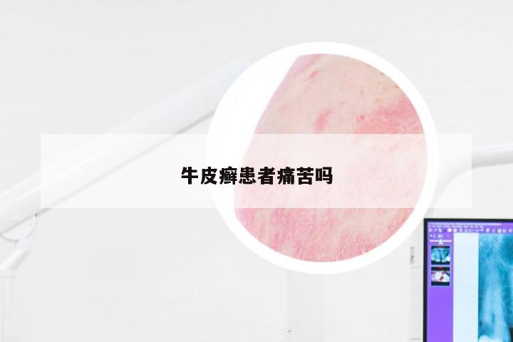 牛皮癣患者痛苦吗