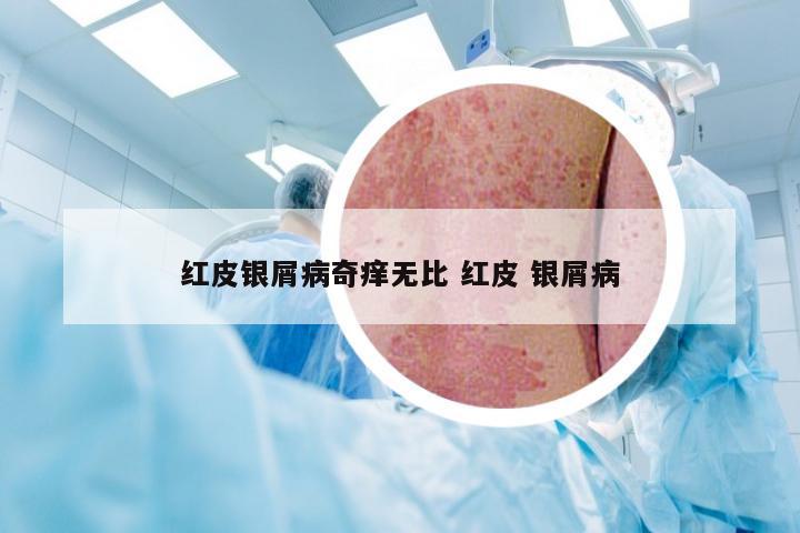 红皮银屑病奇痒无比 红皮 银屑病