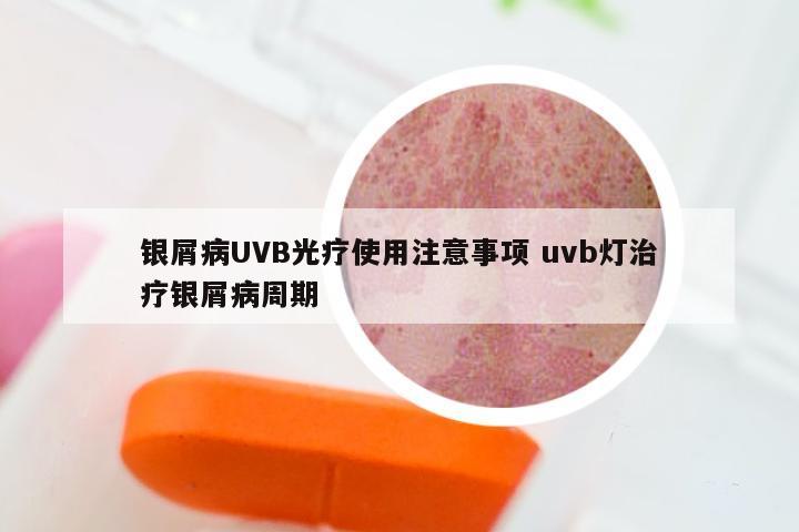 银屑病UVB光疗使用注意事项 uvb灯治疗银屑病周期