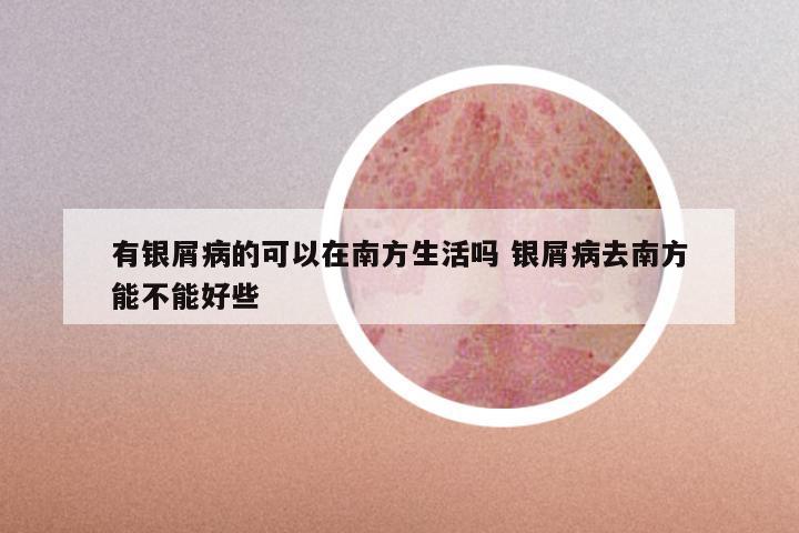 有银屑病的可以在南方生活吗 银屑病去南方能不能好些