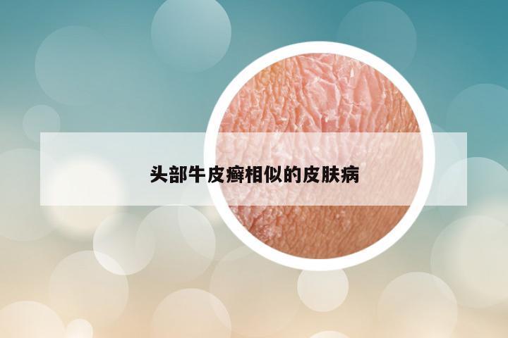 头部牛皮癣相似的皮肤病