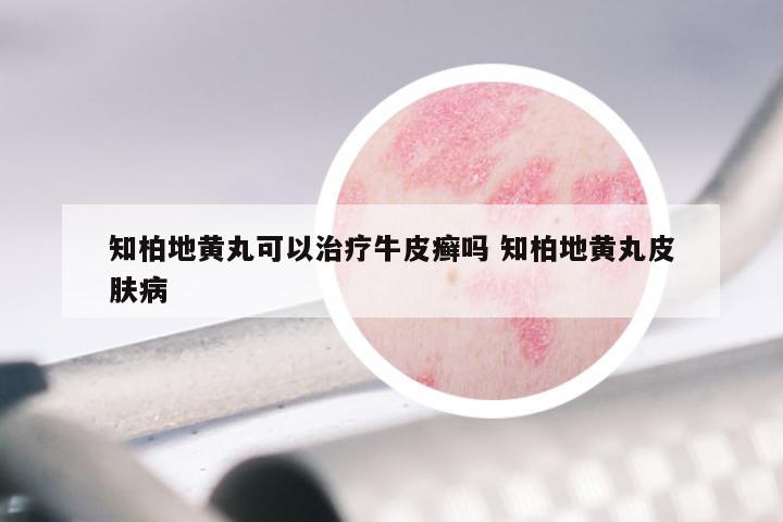 知柏地黄丸可以治疗牛皮癣吗 知柏地黄丸皮肤病