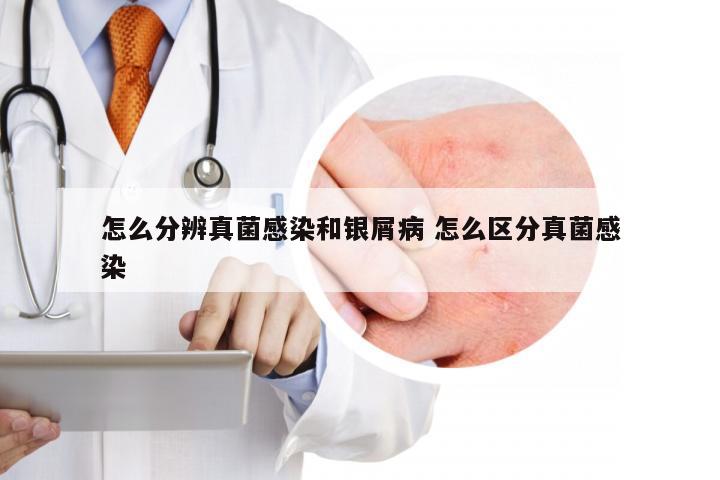 怎么分辨真菌感染和银屑病 怎么区分真菌感染