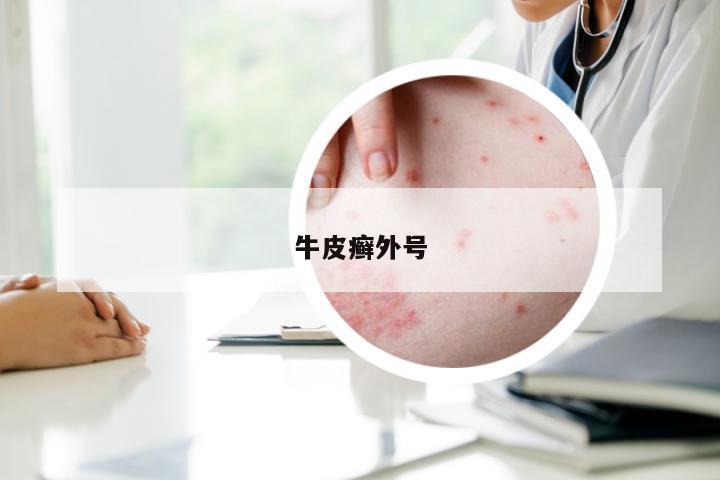 牛皮癣外号