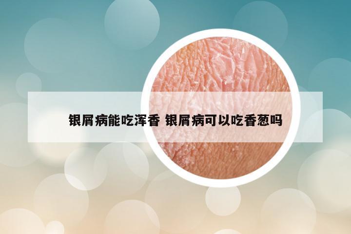银屑病能吃浑香 银屑病可以吃香葱吗