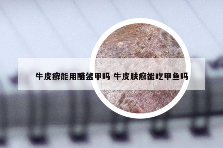 牛皮癣能用醋鳖甲吗 牛皮肤癣能吃甲鱼吗