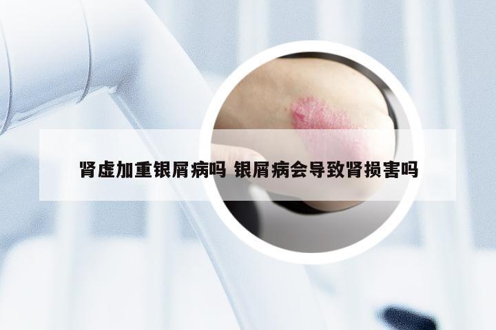 肾虚加重银屑病吗 银屑病会导致肾损害吗