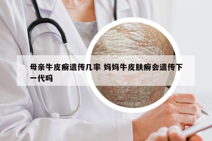 母亲牛皮癣遗传几率 妈妈牛皮肤癣会遗传下一代吗