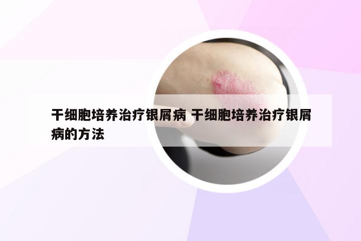干细胞培养治疗银屑病 干细胞培养治疗银屑病的方法